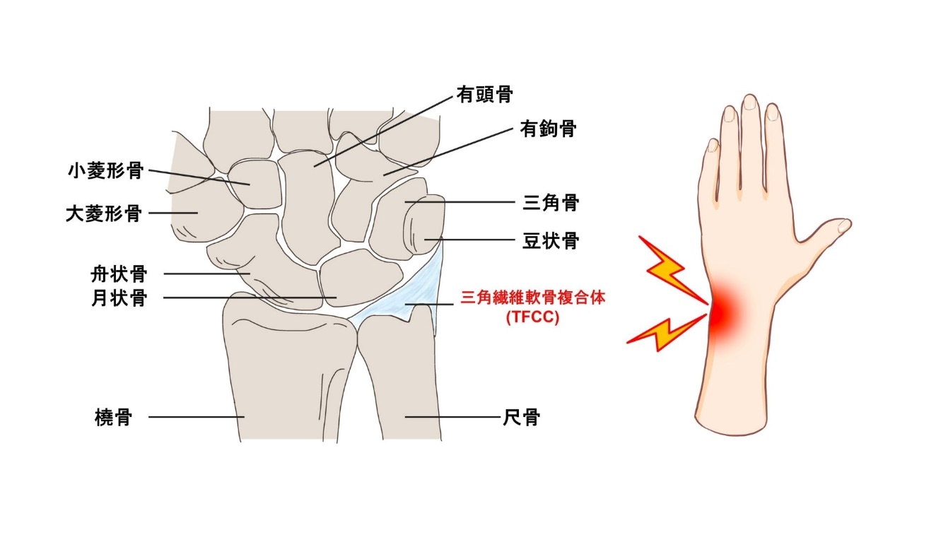 【吉祥寺 TFCC損傷 鍼灸】手首の小指側の痛みでお悩みの方へ