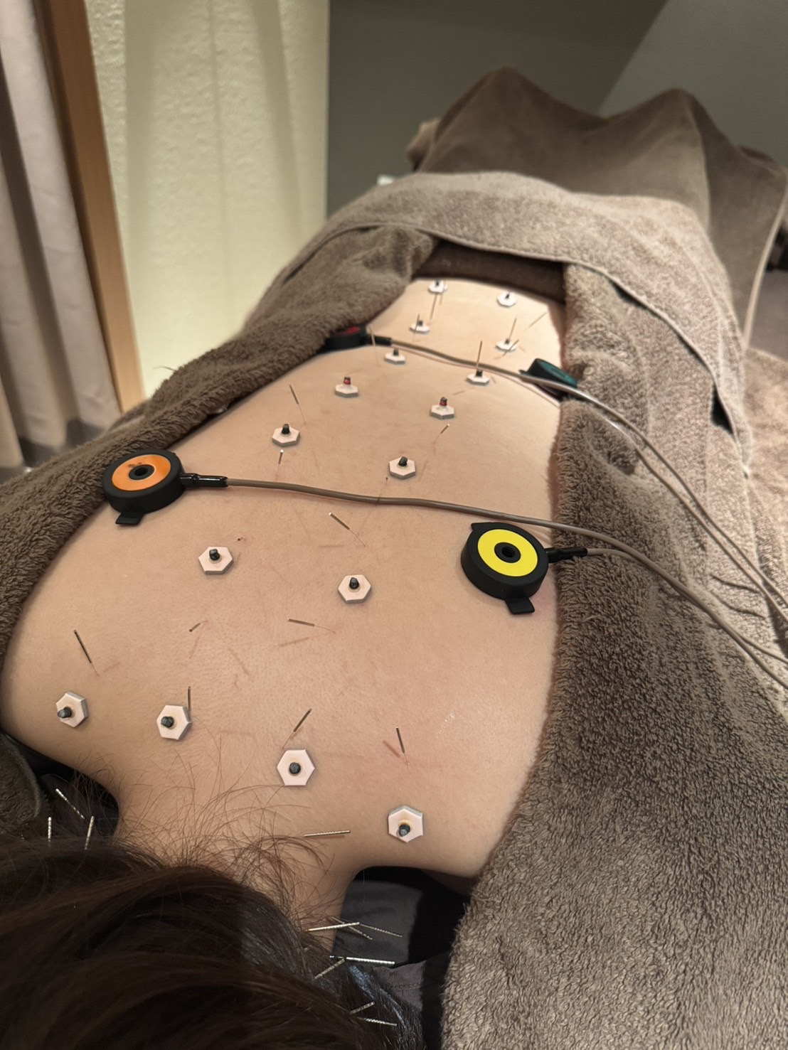 自律神経の乱れによる不調にお悩みの方へ 〜鍼灸で整える心と体のバランス〜