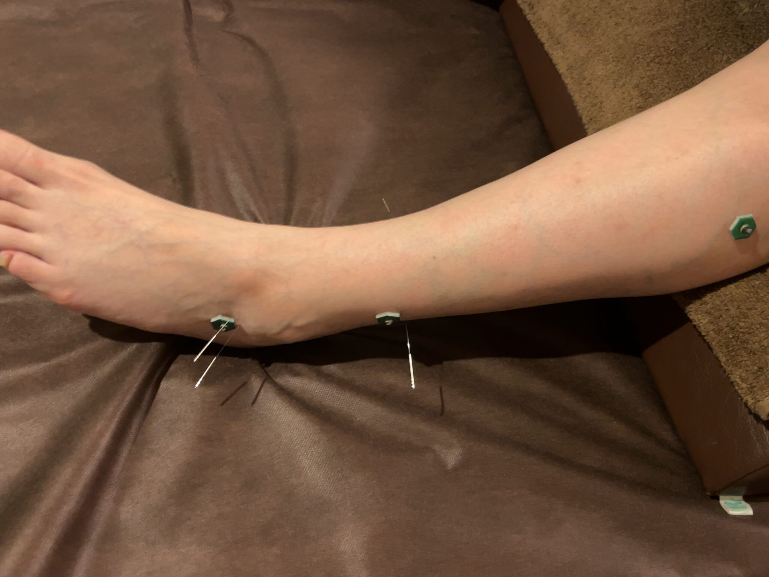 【吉祥寺 三角骨障害 鍼灸】足首の後ろの痛み、特にバレエ・ダンスの不調でお悩みの方へ