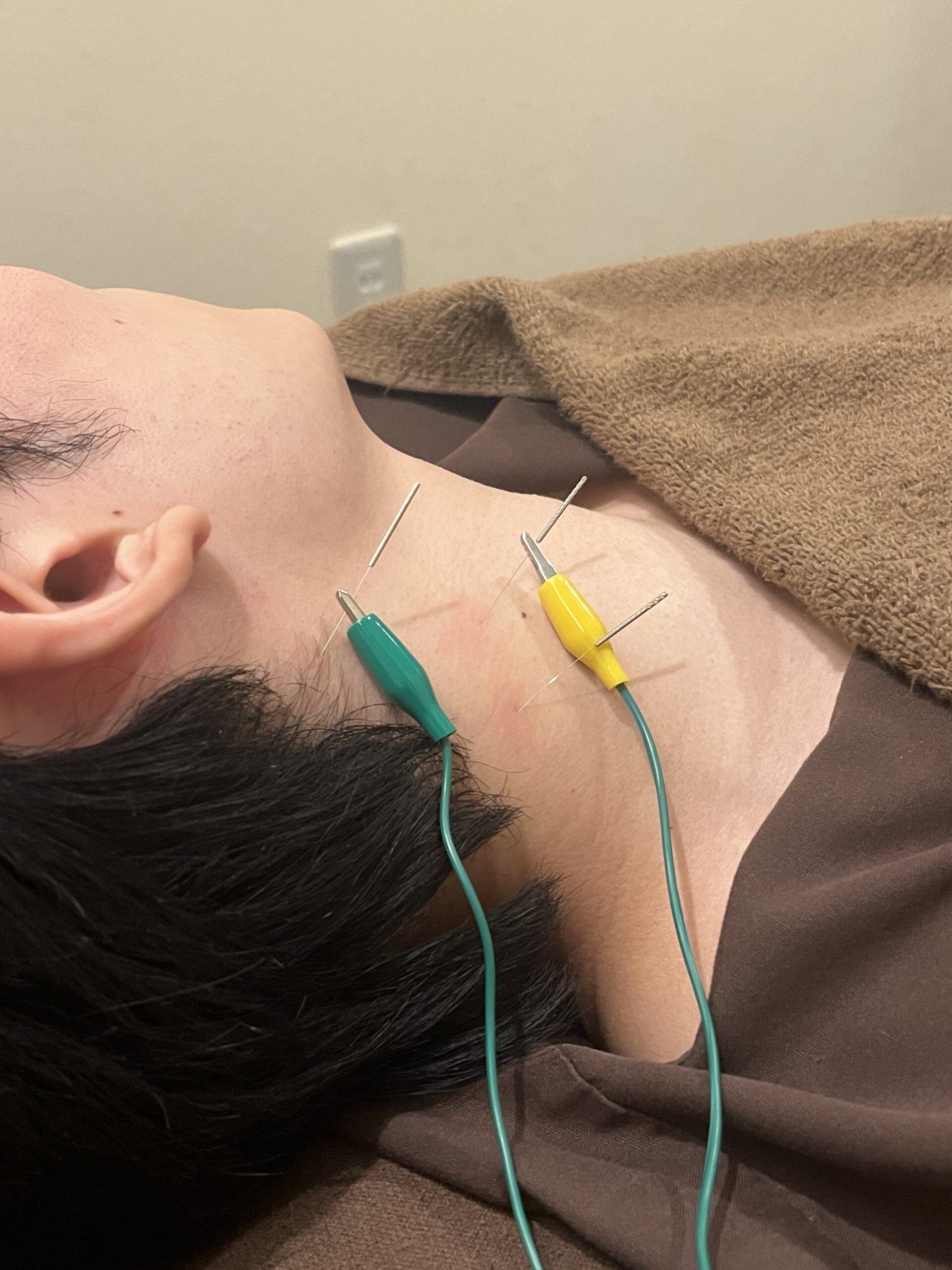 【吉祥寺 ジストニア 鍼灸】意思に反して体が動く・固まる。脳と筋肉の「過緊張」を解きほぐす