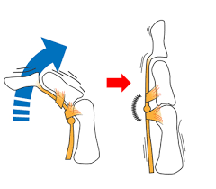 【吉祥寺 ばね指 鍼灸】指の付け根の痛み、カクカクする引っかかりでお悩みの方へ